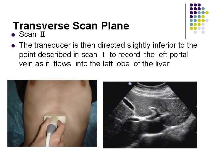 Transverse Scan Plane l l Scan Ⅱ The transducer is then directed slightly inferior