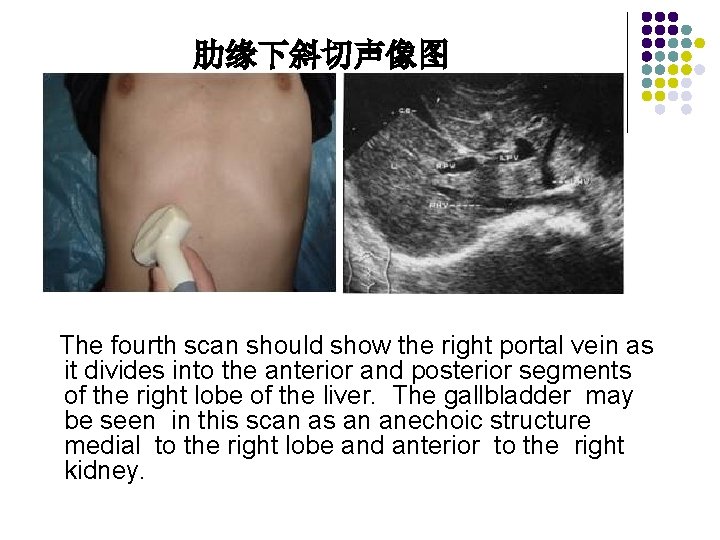 肋缘下斜切声像图 The fourth scan should show the right portal vein as it divides into