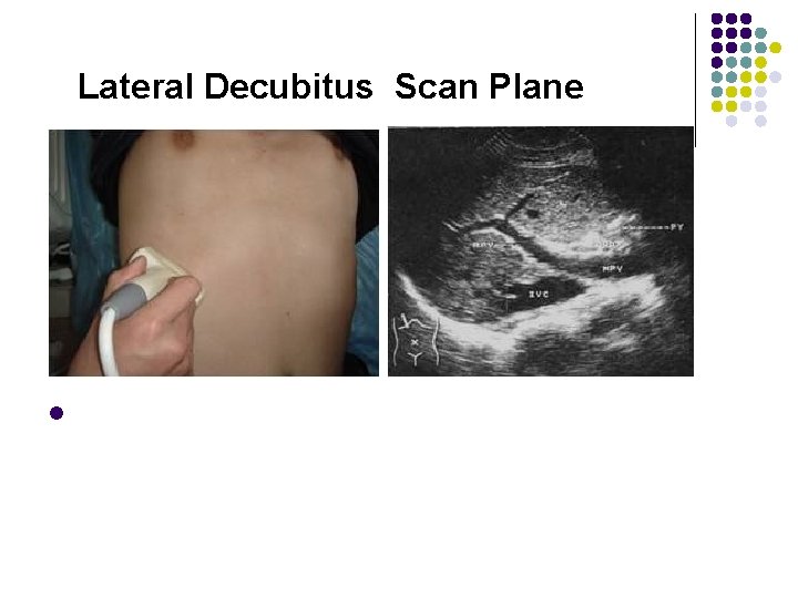 Lateral Decubitus Scan Plane l 