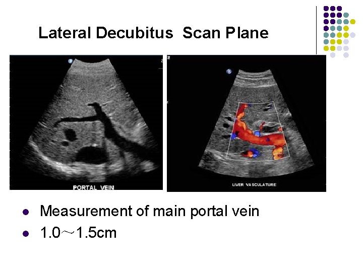 Lateral Decubitus Scan Plane l l Measurement of main portal vein 1. 0～ 1.