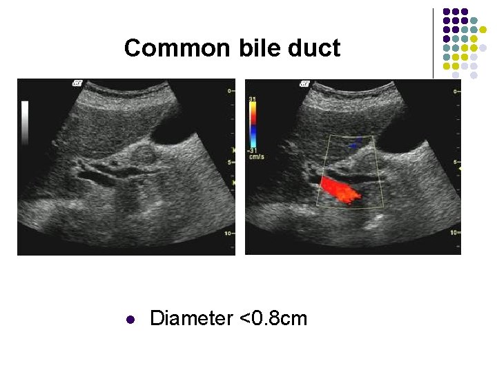 Common bile duct l Diameter <0. 8 cm 