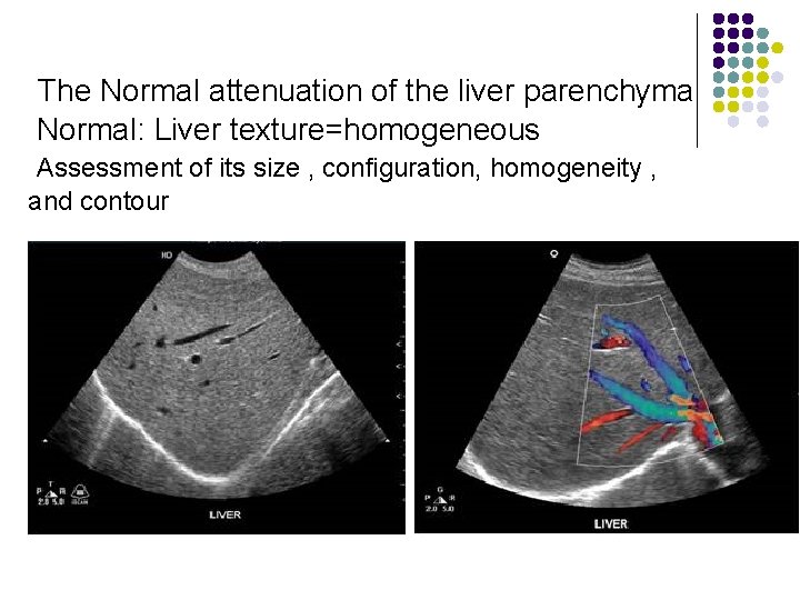 The Normal attenuation of the liver parenchyma Normal: Liver texture=homogeneous Assessment of its size