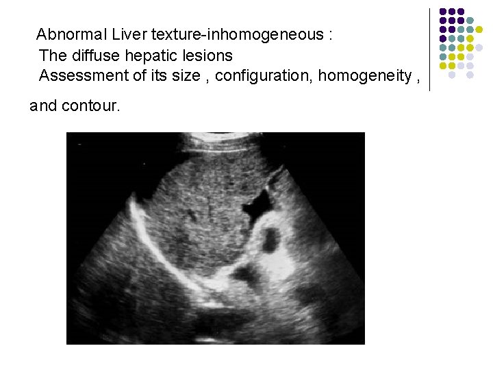 Abnormal Liver texture-inhomogeneous : The diffuse hepatic lesions Assessment of its size , configuration,