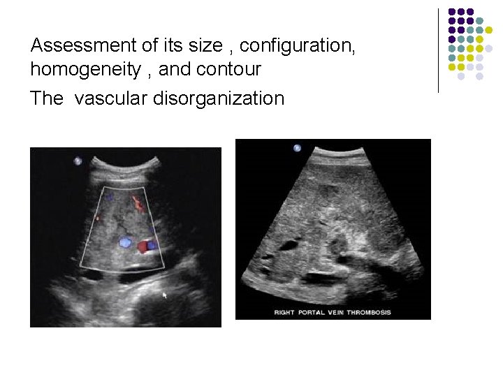 Assessment of its size , configuration, homogeneity , and contour The vascular disorganization 