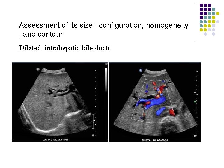 Assessment of its size , configuration, homogeneity , and contour Dilated intrahepatic bile ducts