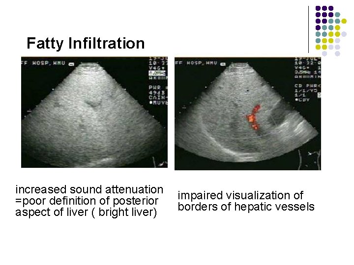 Fatty Infiltration increased sound attenuation =poor definition of posterior aspect of liver ( bright