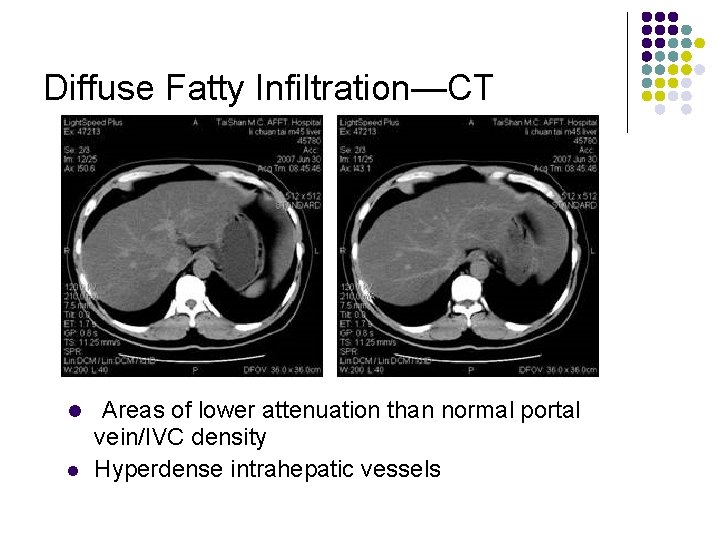 Diffuse Fatty Infiltration—CT l l Areas of lower attenuation than normal portal vein/IVC density