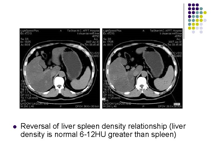 l Reversal of liver spleen density relationship (liver density is normal 6 -12 HU