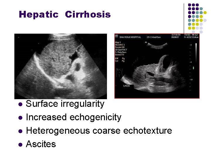 Hepatic Cirrhosis l l Surface irregularity Increased echogenicity Heterogeneous coarse echotexture Ascites 