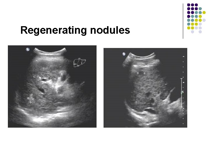 Regenerating nodules 