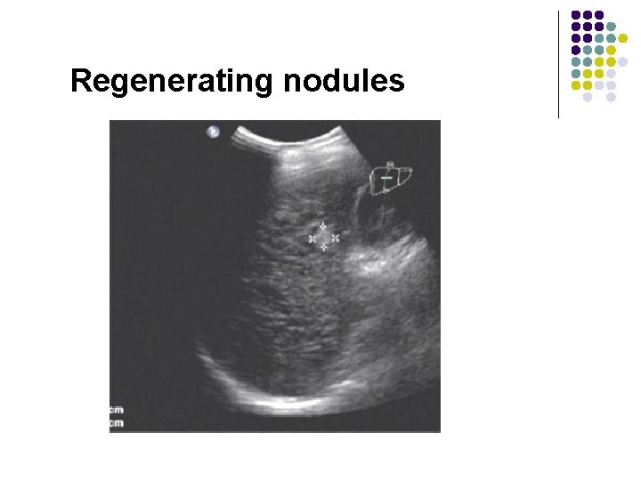 Regenerating nodules 