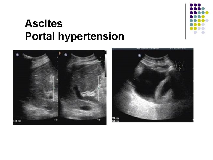 Ascites Portal hypertension 