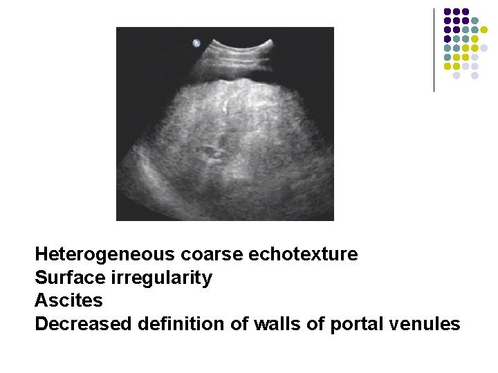 Heterogeneous coarse echotexture Surface irregularity Ascites Decreased definition of walls of portal venules 