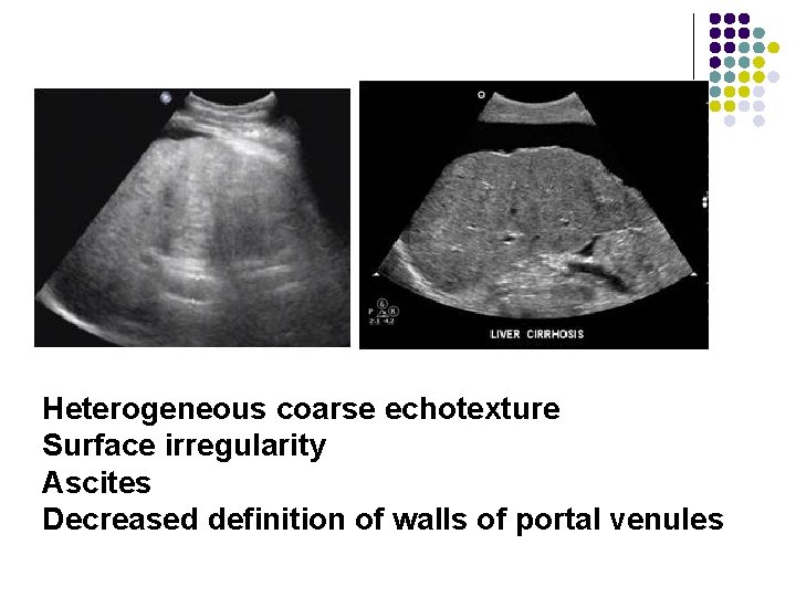 Heterogeneous coarse echotexture Surface irregularity Ascites Decreased definition of walls of portal venules 
