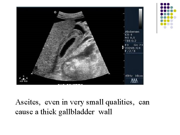 Ascites, even in very small qualities, can cause a thick gallbladder wall 