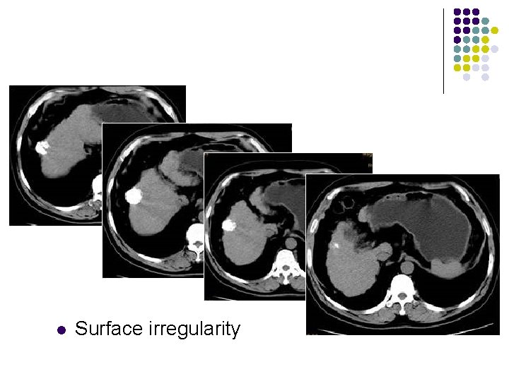 l Surface irregularity 
