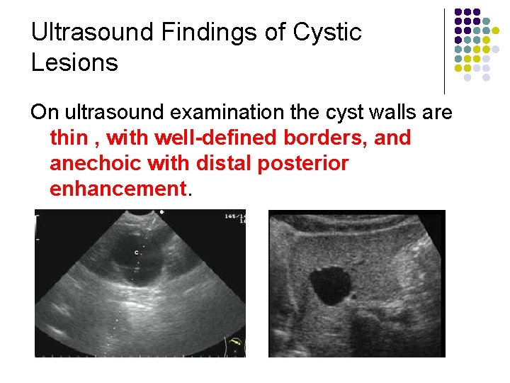 Ultrasound Findings of Cystic Lesions On ultrasound examination the cyst walls are thin ,