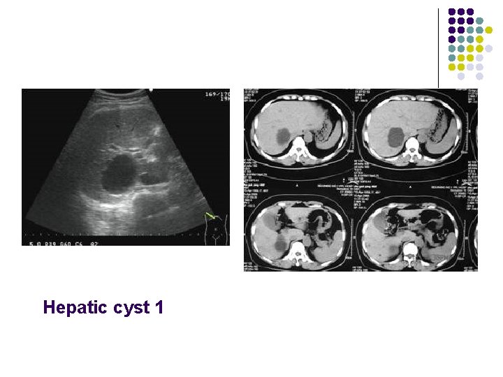 Hepatic cyst 1 