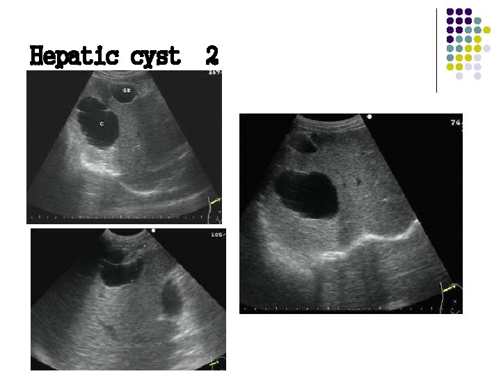Hepatic cyst 2 