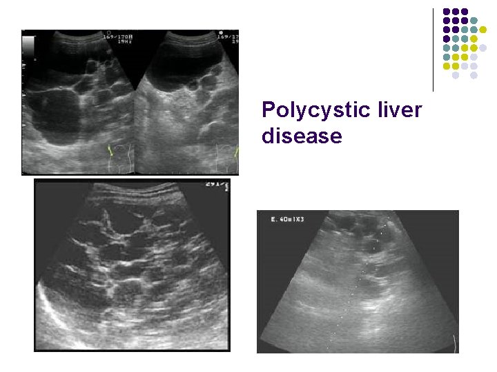 Polycystic liver disease 