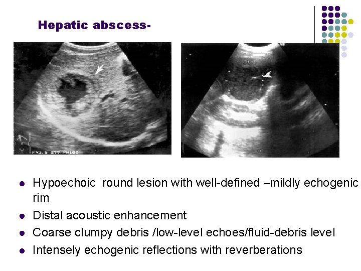 Hepatic abscess- l l Hypoechoic round lesion with well-defined –mildly echogenic rim Distal acoustic