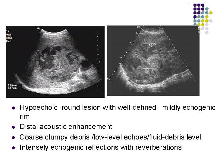 l l Hypoechoic round lesion with well-defined –mildly echogenic rim Distal acoustic enhancement Coarse