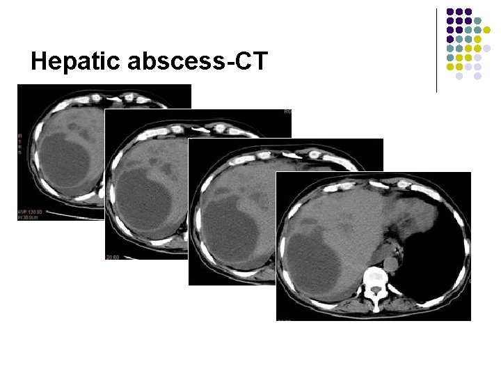 Hepatic abscess-CT 