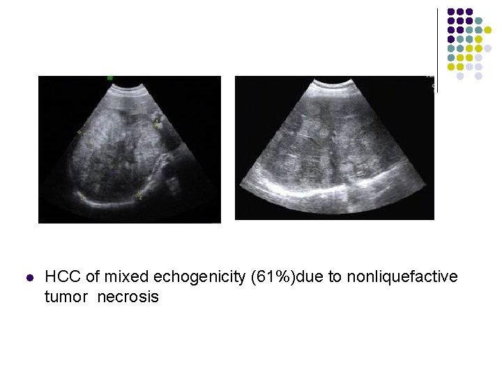 l HCC of mixed echogenicity (61%)due to nonliquefactive tumor necrosis 