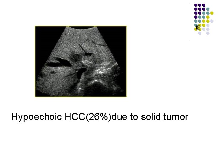 Hypoechoic HCC(26%)due to solid tumor 