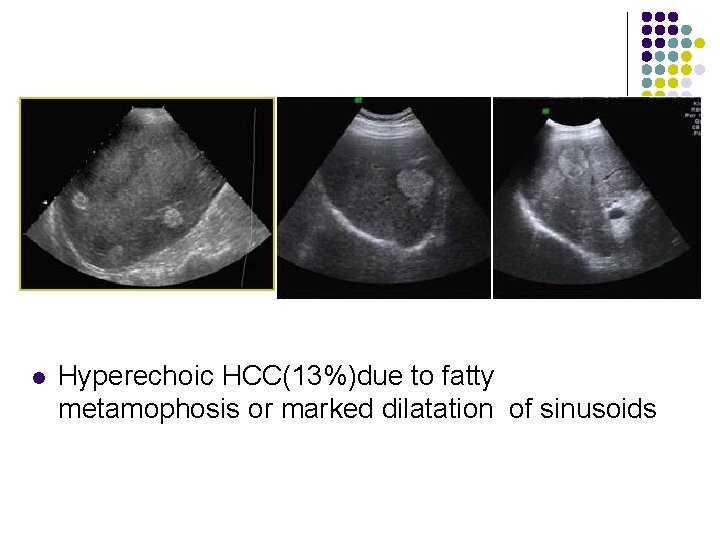l Hyperechoic HCC(13%)due to fatty metamophosis or marked dilatation of sinusoids 