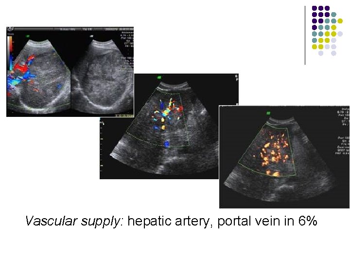 Vascular supply: hepatic artery, portal vein in 6% 