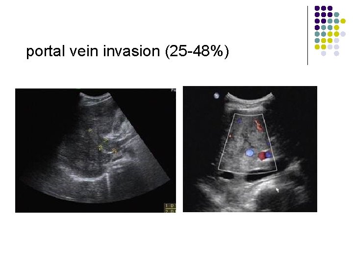 portal vein invasion (25 -48%) 