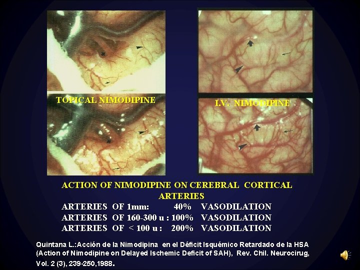 TOPICAL NIMODIPINE I. V. NIMODIPINE ACTION OF NIMODIPINE ON CEREBRAL CORTICAL ARTERIES OF 1