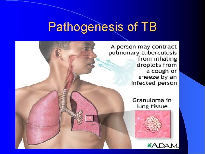Pathogenesis of TB 