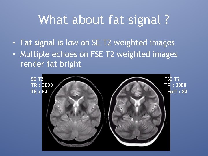 What about fat signal ? • Fat signal is low on SE T 2