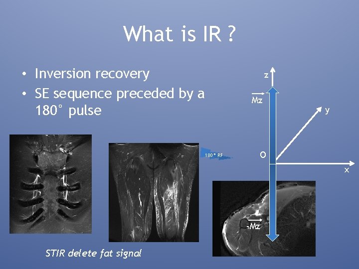 What is IR ? • Inversion recovery • SE sequence preceded by a 180°