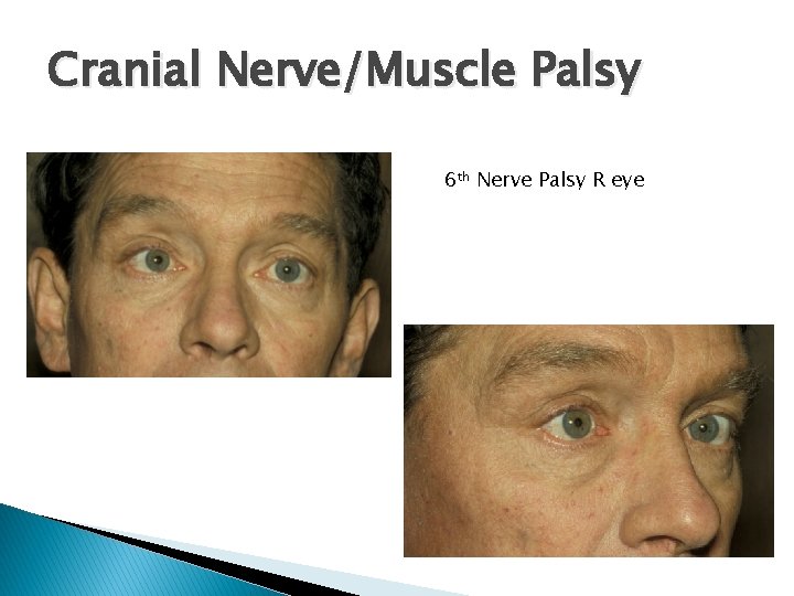 Cranial Nerve/Muscle Palsy 6 th Nerve Palsy R eye 
