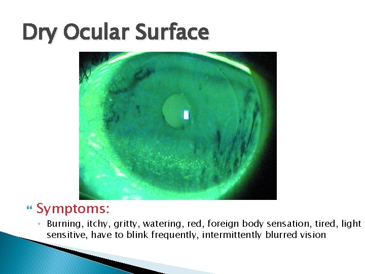 Dry Ocular Surface Symptoms: ◦ Burning, itchy, gritty, watering, red, foreign body sensation, tired,