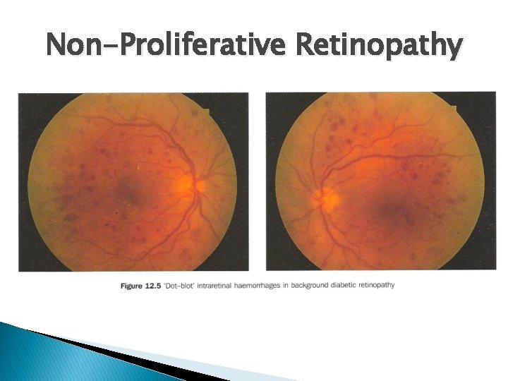 Non-Proliferative Retinopathy 