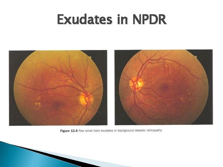 Exudates in NPDR 