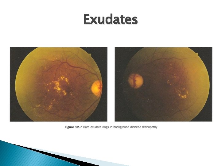 Exudates 
