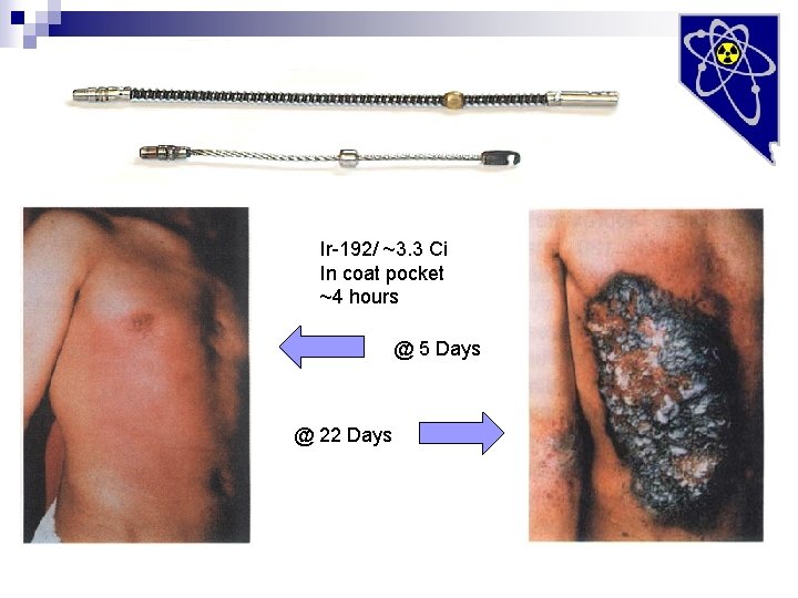 Ir-192/ ~3. 3 Ci In coat pocket ~4 hours @ 5 Days @ 22