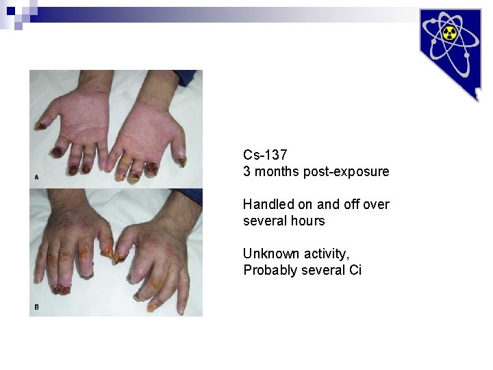 Cs-137 3 months post-exposure Handled on and off over several hours Unknown activity, Probably