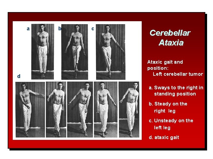 a d b c Cerebellar Ataxia Ataxic gait and position: Left cerebellar tumor a.