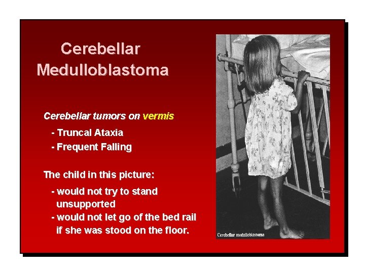 Cerebellar Medulloblastoma Cerebellar tumors on vermis - Truncal Ataxia - Frequent Falling The child