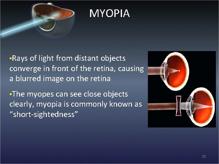 MYOPIA • Rays of light from distant objects converge in front of the retina,