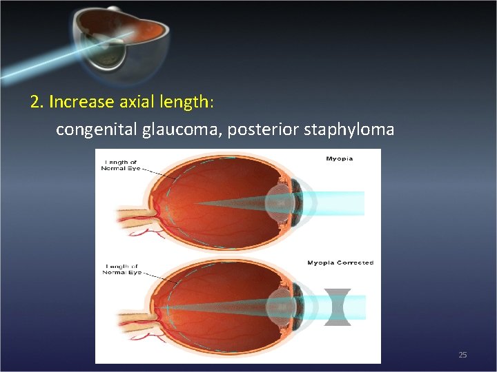 2. Increase axial length: congenital glaucoma, posterior staphyloma 25 