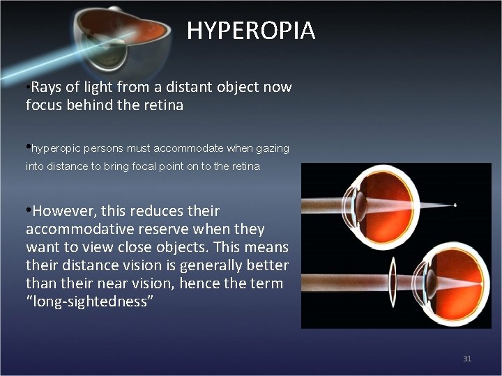 HYPEROPIA • Rays of light from a distant object now focus behind the retina