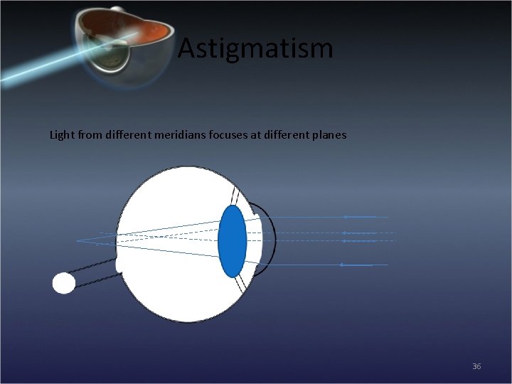 Astigmatism Light from different meridians focuses at different planes 36 