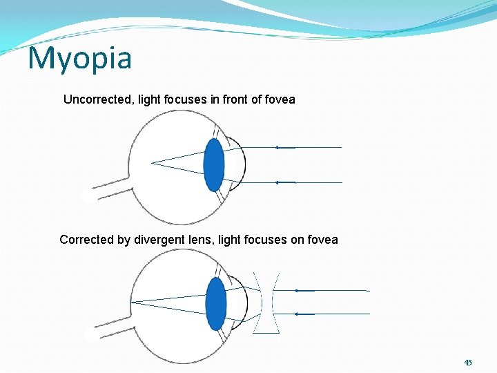 Myopia Uncorrected, light focuses in front of fovea Corrected by divergent lens, light focuses